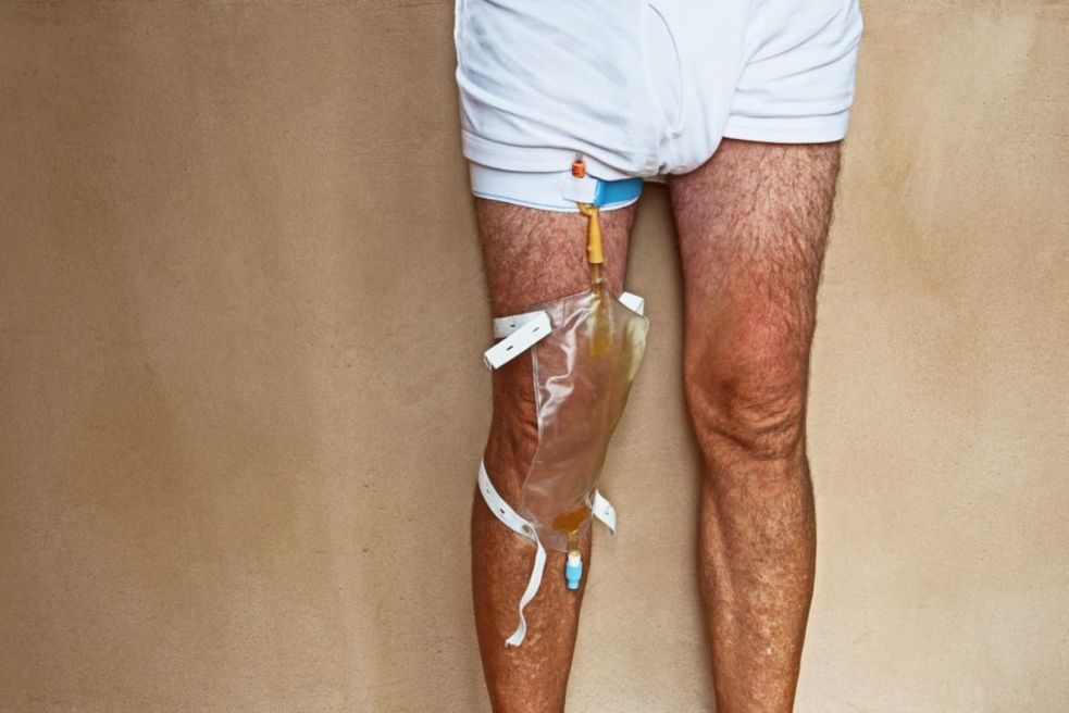 sonda urinara barbati permanenta sânge cu prostatită