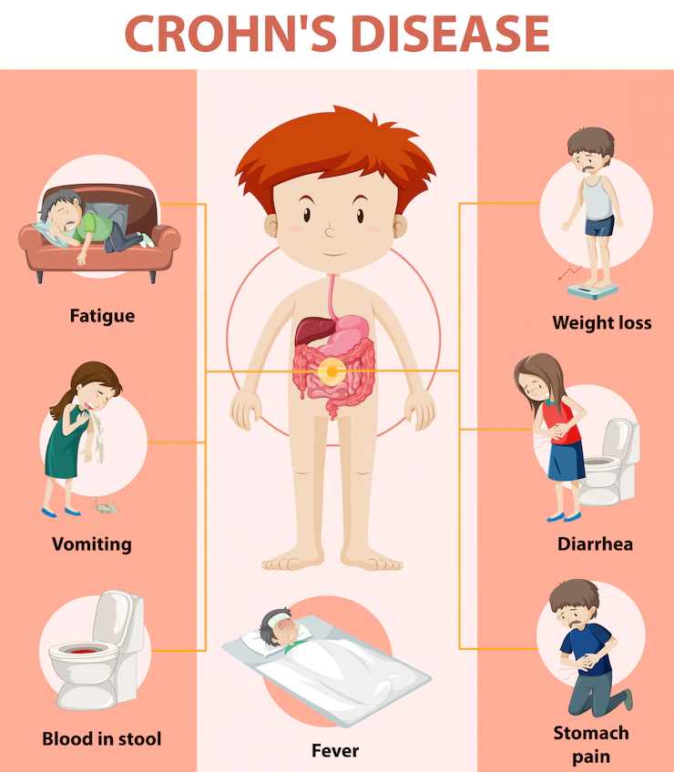 2. Boala Crohn simptome - Care sunt cele mai frecvente simptome ale bolii Crohn_Exemple de simptome in boala Crohn