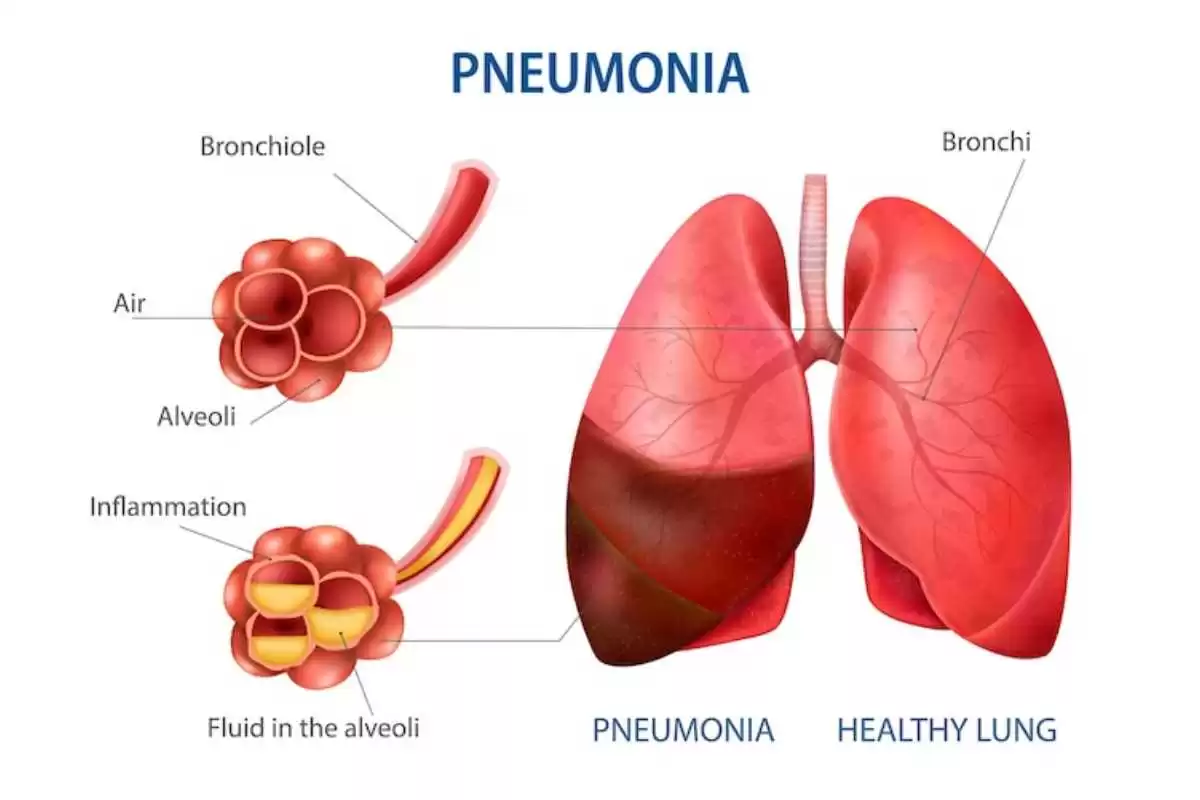Pneumonia, grafic, plamani, Trumed.ro